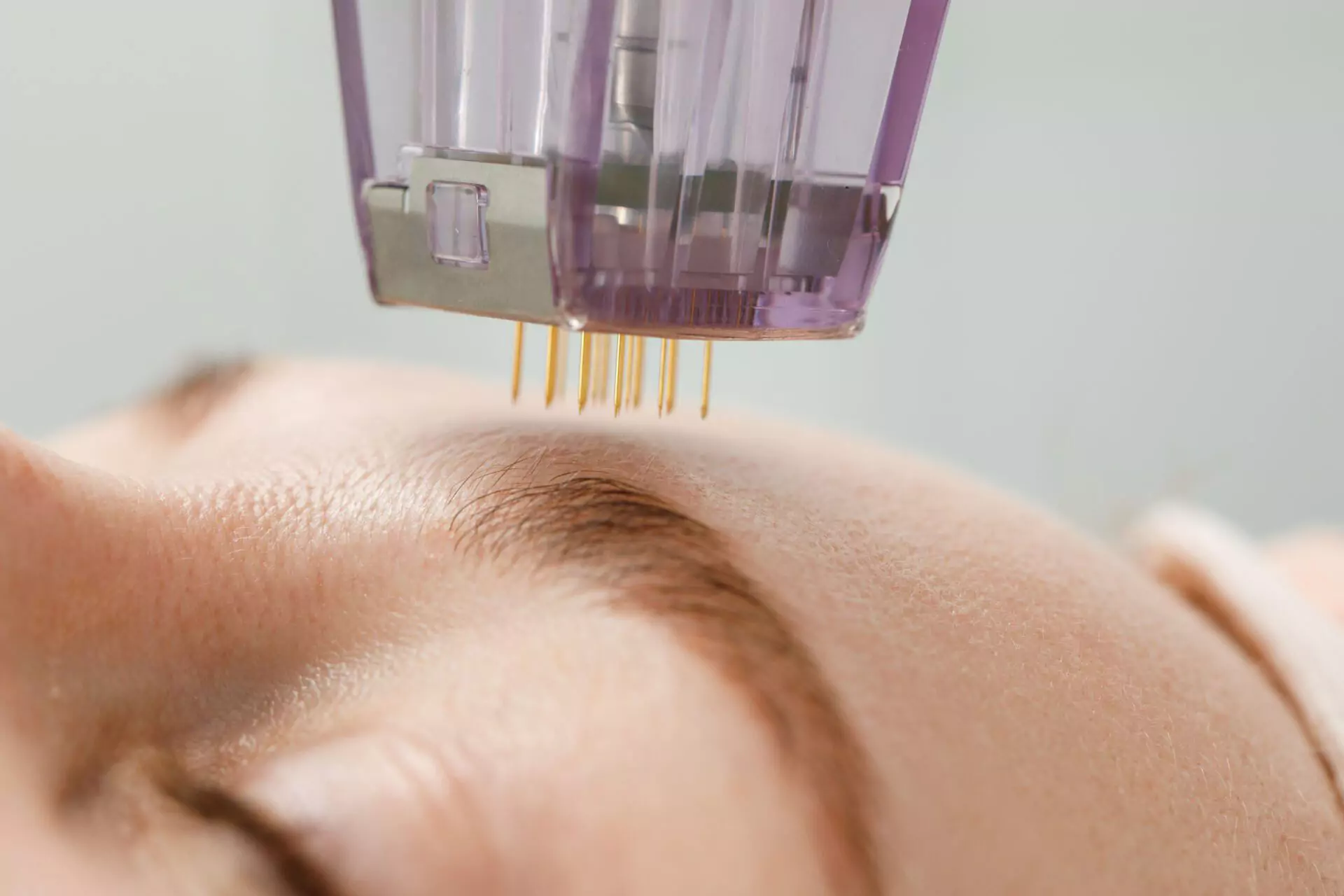 Traditional Microneedling vs. Morpheus8 Radiofrequency Microneedling