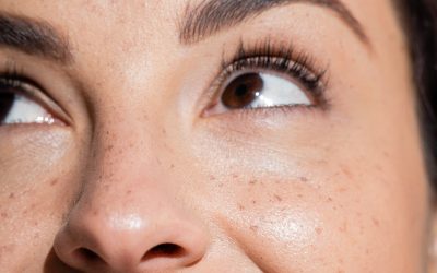 Facials vs. IPL: Skin Treatments in Mount Pleasant, SC