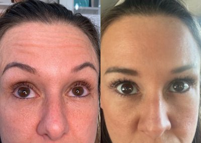 Southern Grace Aesthetics Client before and after botox picture showing natural results