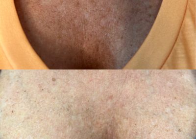 Before & After Older woman with sun damage and age spots to chest area. After treatment at Southern Grace Aesthetics, noticeable change