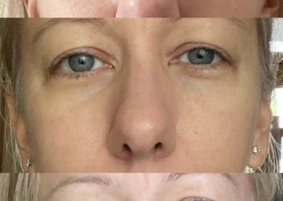 3 photos of a Southern Grace Aesthetics client who received bio-filler/PRP/PRF to address under eye hollowness and "tired" look.