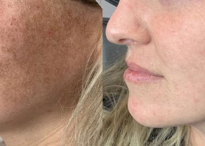 A before & After image of a Southern Grace Aesthetics clients before and after a chemical peel treatment showing a very noticeable difference no more age spots or sun damage