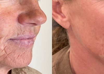 Older woman with significant lines around mouth from aging and smoking. The after results show significant reduction in lines after using Radiesse Gold