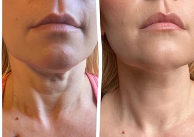 Picture of Southern Grace Aesthetics clients before and after receiving skin tightening treatment to neck area