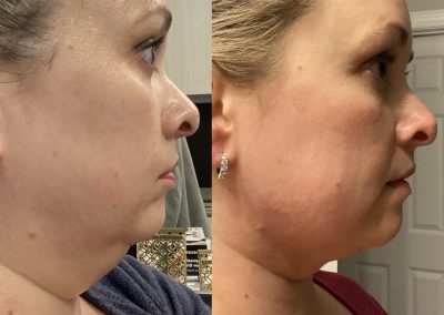 Southern Grace Aesthetics client before & after microneedling, skin tightening treatment to neck area showing great results