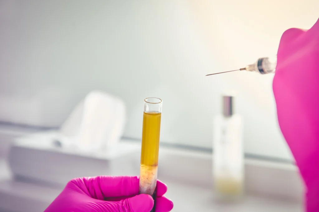 PRP and PRF plasma vial and syringe for bio-filler treatment